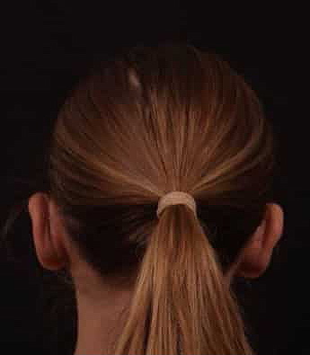 After Image: Otoplasty - back