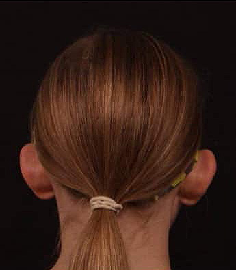 Before Image: Otoplasty - back