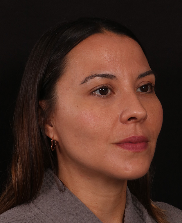 After Image: Neck Liposuction and Buccal Fat Removal - right-front-oblique