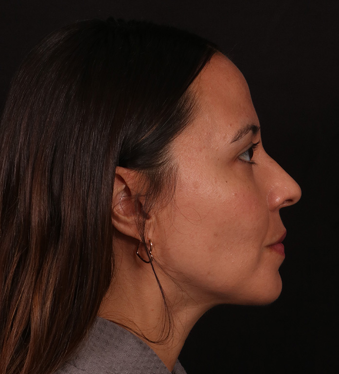 After Image: Neck Liposuction and Buccal Fat Removal - right-side