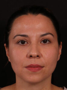 Before Image: Neck Liposuction and Buccal Fat Removal