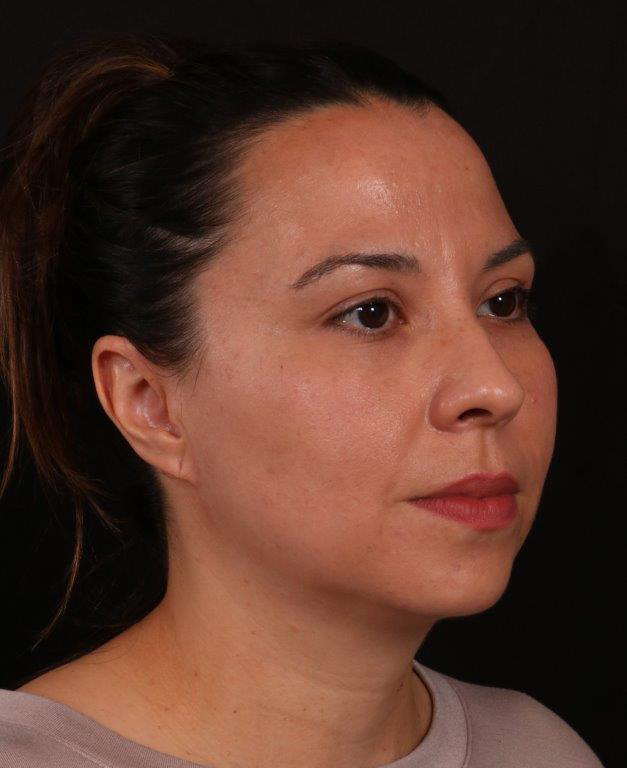Before Image: Neck Liposuction and Buccal Fat Removal - right-front-oblique