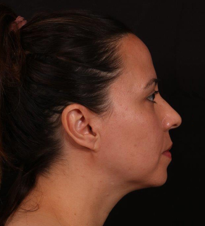 Before Image: Neck Liposuction and Buccal Fat Removal - right-side