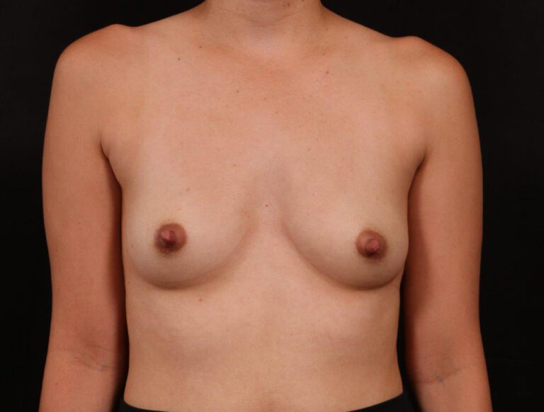 Before Image: Breast Augmentation - front
