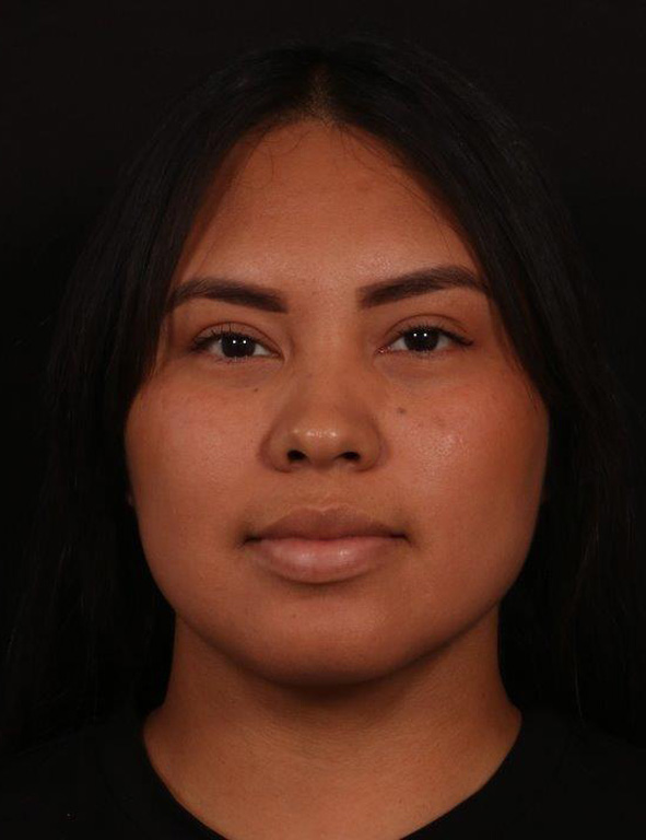 After Image: Neck Liposuction - front
