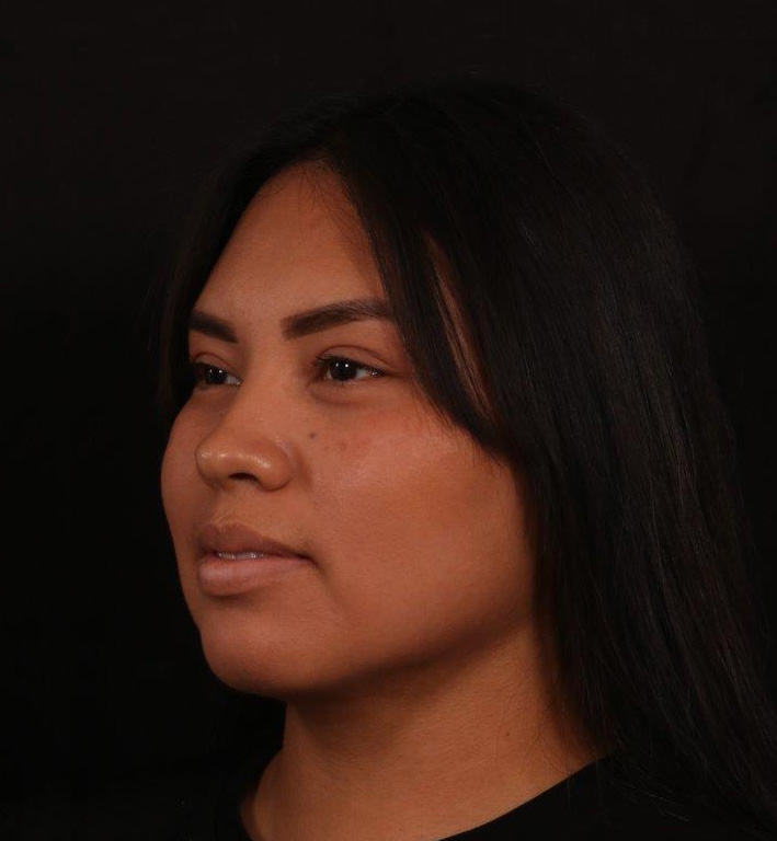 After Image: Neck Liposuction - left-front-oblique