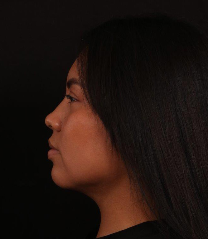After Image: Neck Liposuction - left-side