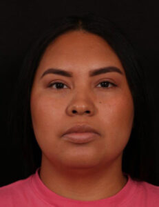 Neck Liposuction