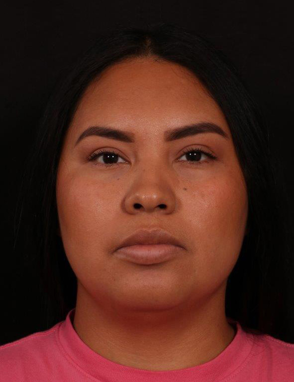 Before Image: Neck Liposuction - front