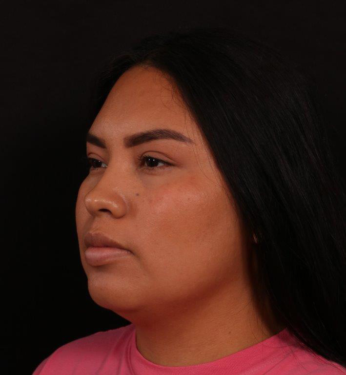 Before Image: Neck Liposuction - left-front-oblique