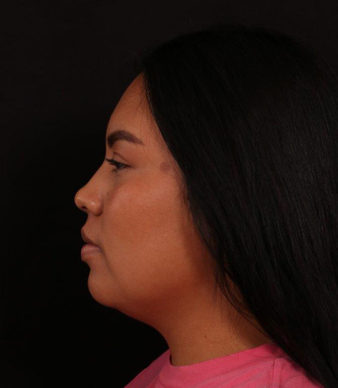 Before Image: Neck Liposuction - left-side