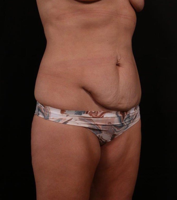 Before Image: Tummy Tuck - right-front-oblique