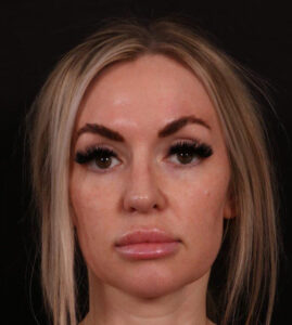 After Image: Revision Rhinoplasty