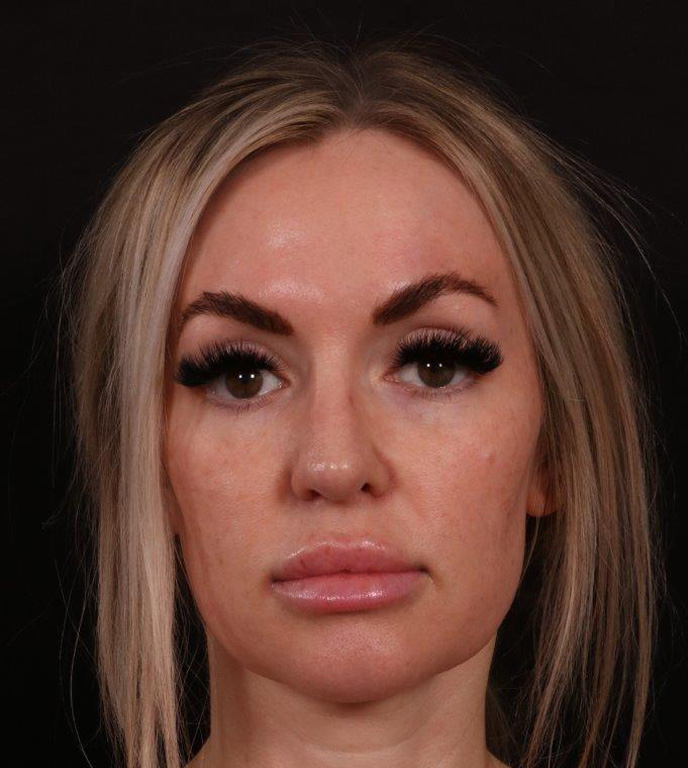 After Image: Revision Rhinoplasty - front