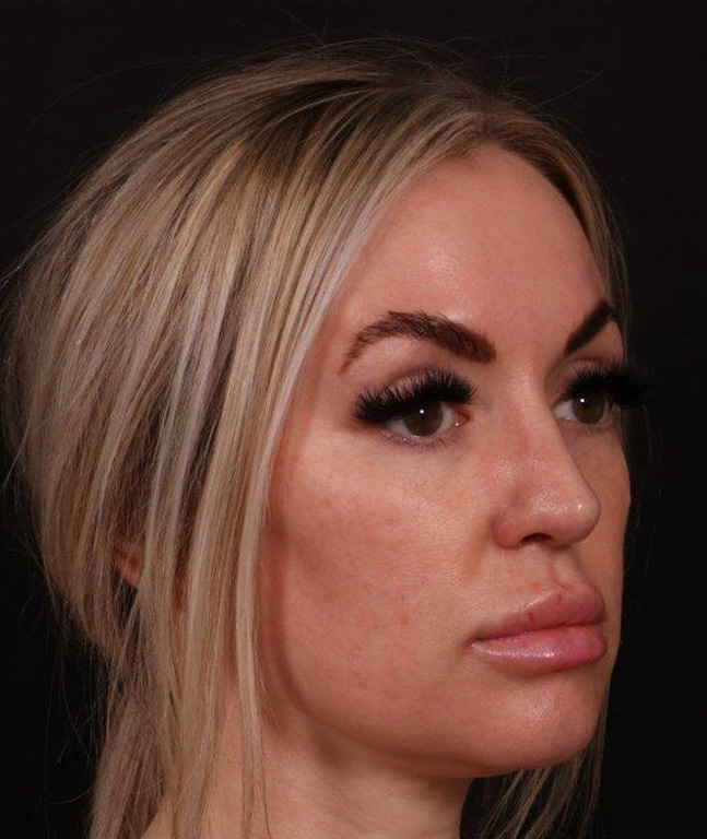 After Image: Revision Rhinoplasty - right-front-oblique