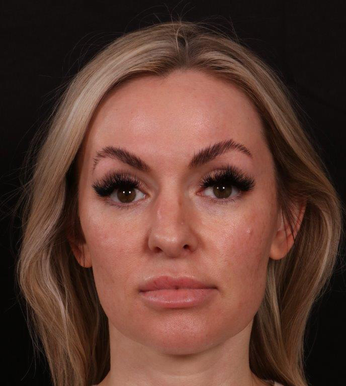 Before Image: Revision Rhinoplasty - front