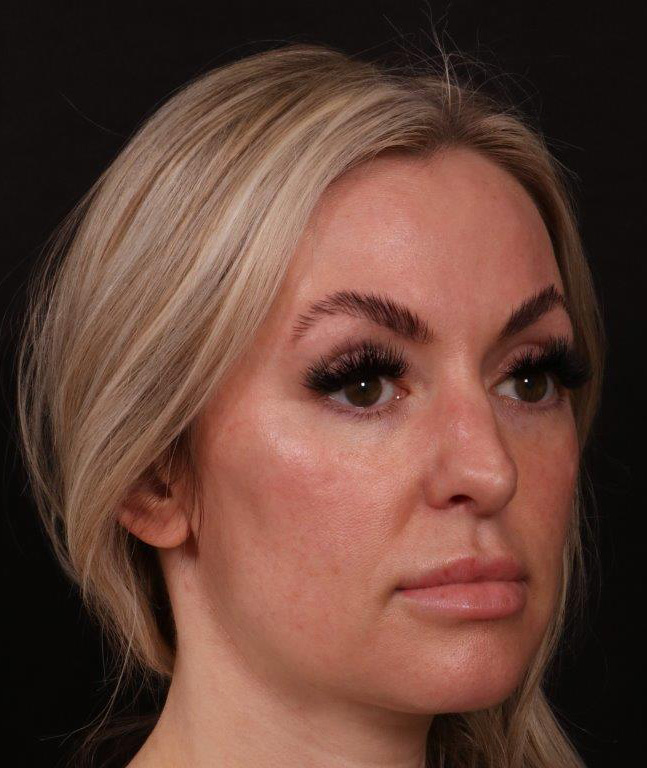 Before Image: Revision Rhinoplasty - right-front-oblique
