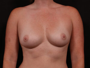 Breast Augmentation