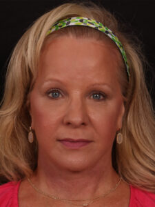 After Image: Lower Facelift and Blepharoplasty