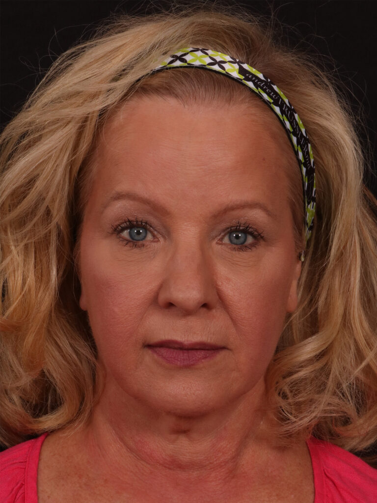 Before Image: Lower Facelift and Blepharoplasty - front