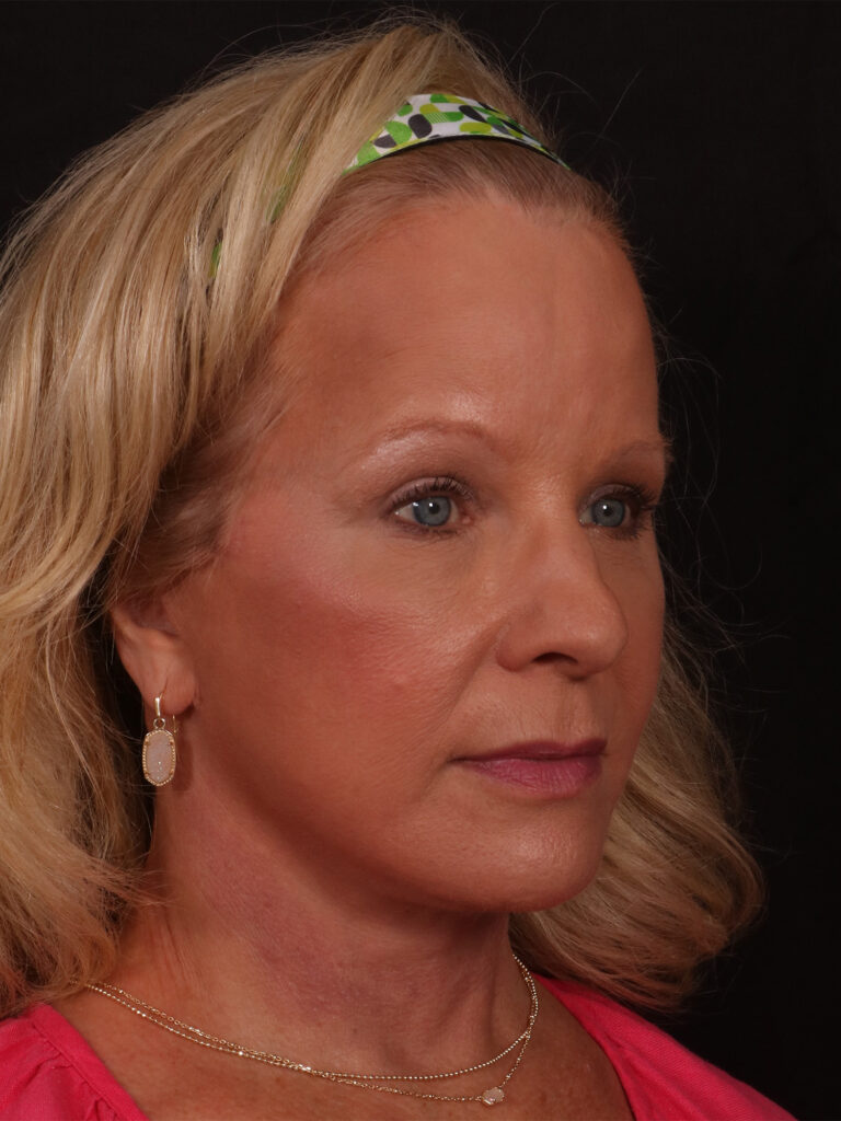 After Image: Lower Facelift and Blepharoplasty - right-front-oblique