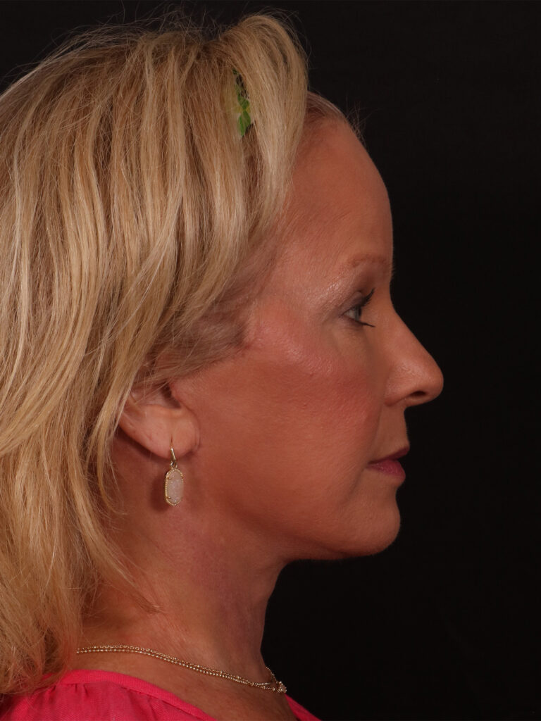After Image: Lower Facelift and Blepharoplasty - right-side