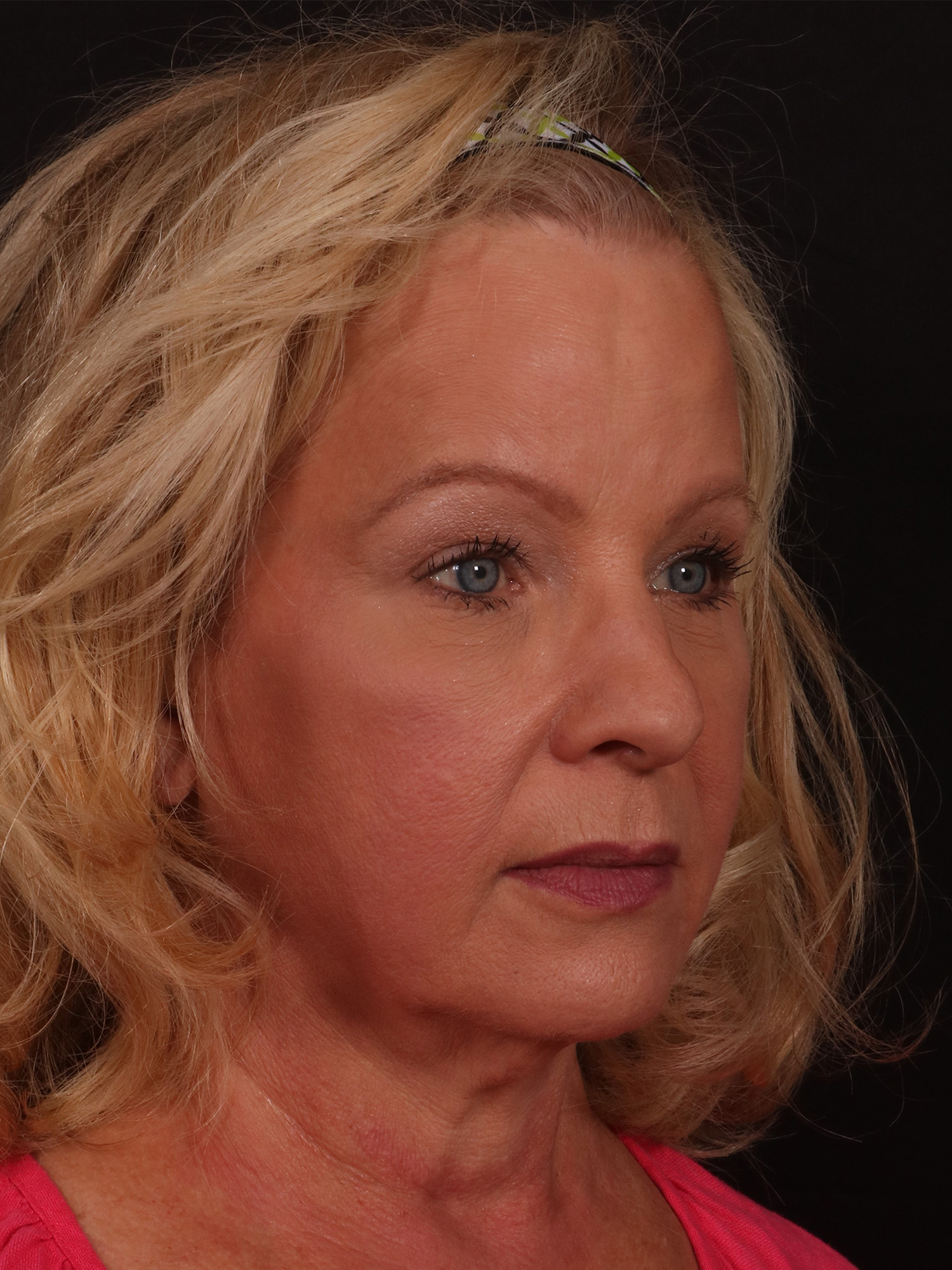 Before Image: Lower Facelift and Blepharoplasty - right-front-oblique