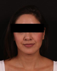 Buccal Fat Removal and Neck Liposuction