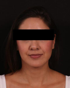 After Image: Buccal Fat Removal and Neck Liposuction