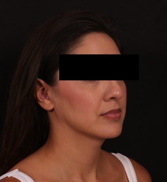 After Image: Buccal Fat Removal and Neck Liposuction - right-front-oblique