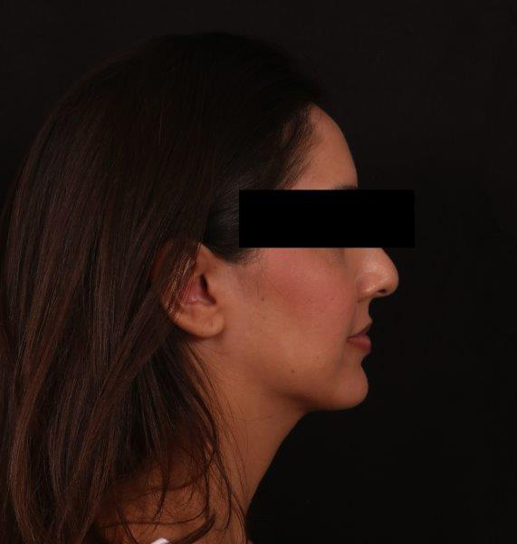 After Image: Buccal Fat Removal and Neck Liposuction - right-side