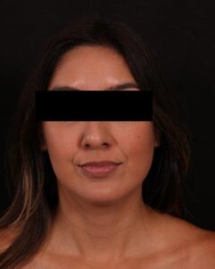 Before Image: Buccal Fat Removal and Neck Liposuction