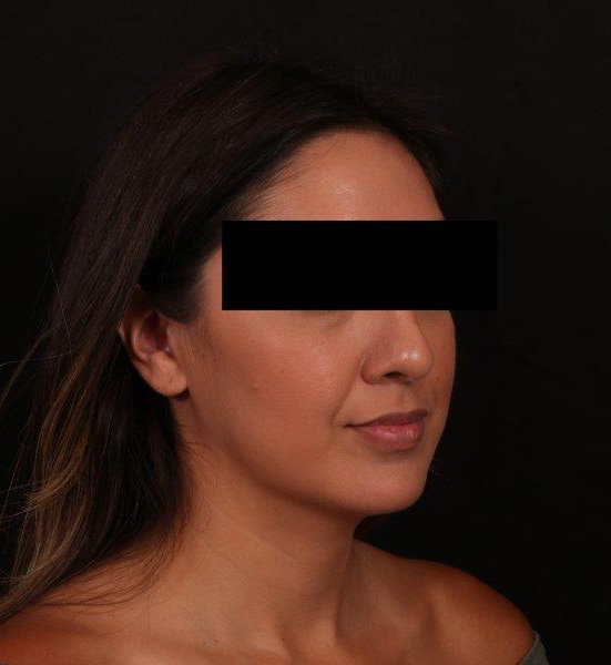 Before Image: Buccal Fat Removal and Neck Liposuction - right-front-oblique