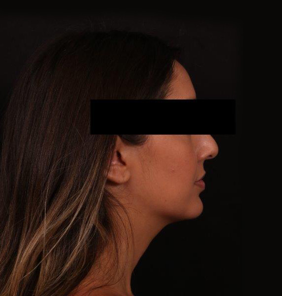 Before Image: Buccal Fat Removal and Neck Liposuction - right-side