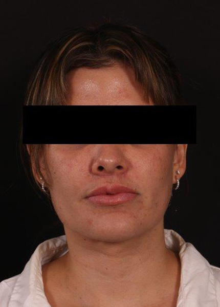 After Image: Neck Liposuction - front