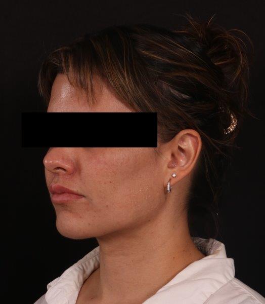 After Image: Neck Liposuction - left-front-oblique