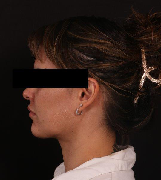 After Image: Neck Liposuction - left-side