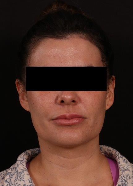 Before Image: Neck Liposuction - front