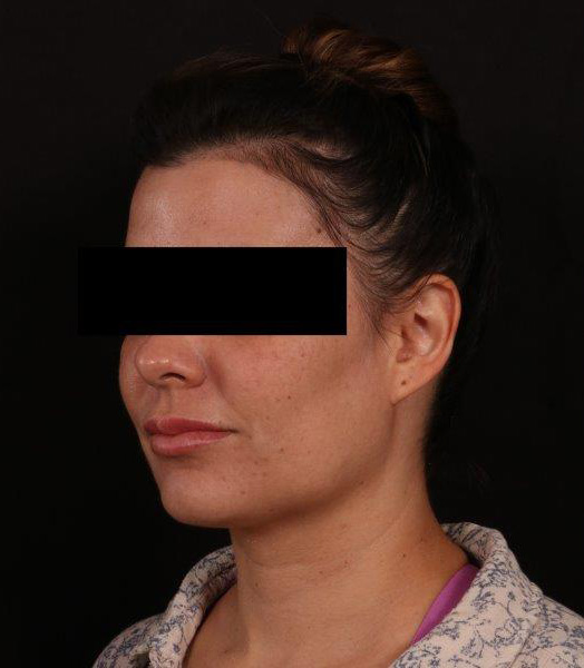 Before Image: Neck Liposuction - left-front-oblique