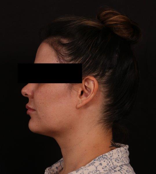 Before Image: Neck Liposuction - left-side