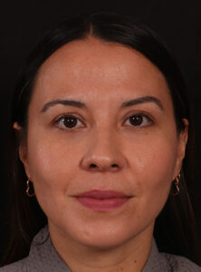 After Image: Neck Liposuction and Buccal Fat Removal