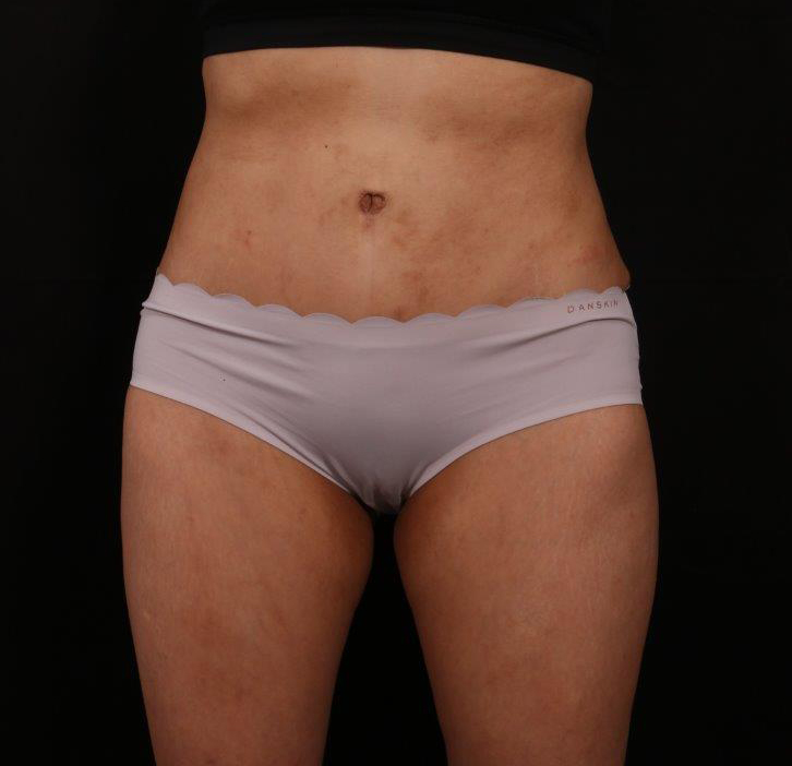 After Image: Tummy Tuck - front