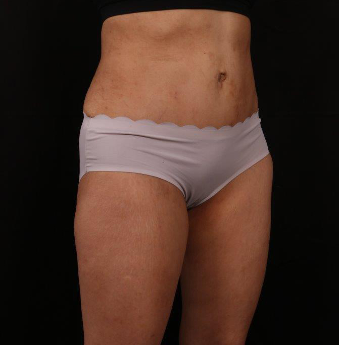 After Image: Tummy Tuck - right-front-oblique
