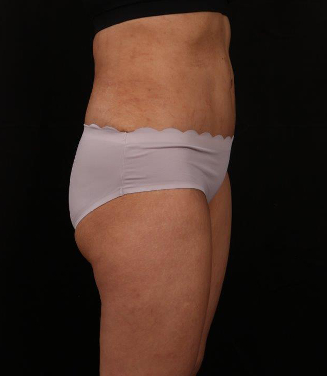 After Image: Tummy Tuck - right-side
