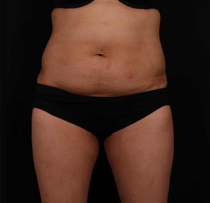 Before Image: Tummy Tuck - front