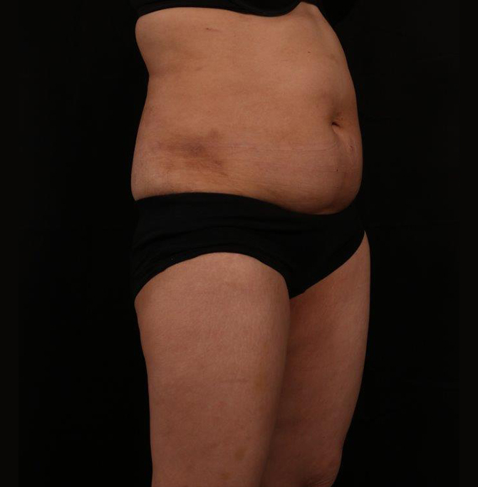 Before Image: Tummy Tuck - right-front-oblique