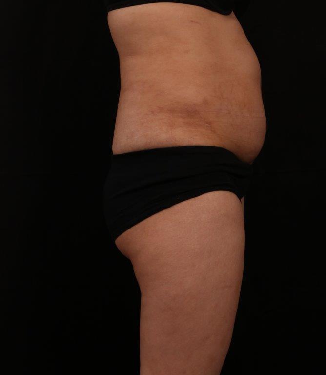 Before Image: Tummy Tuck - right-side