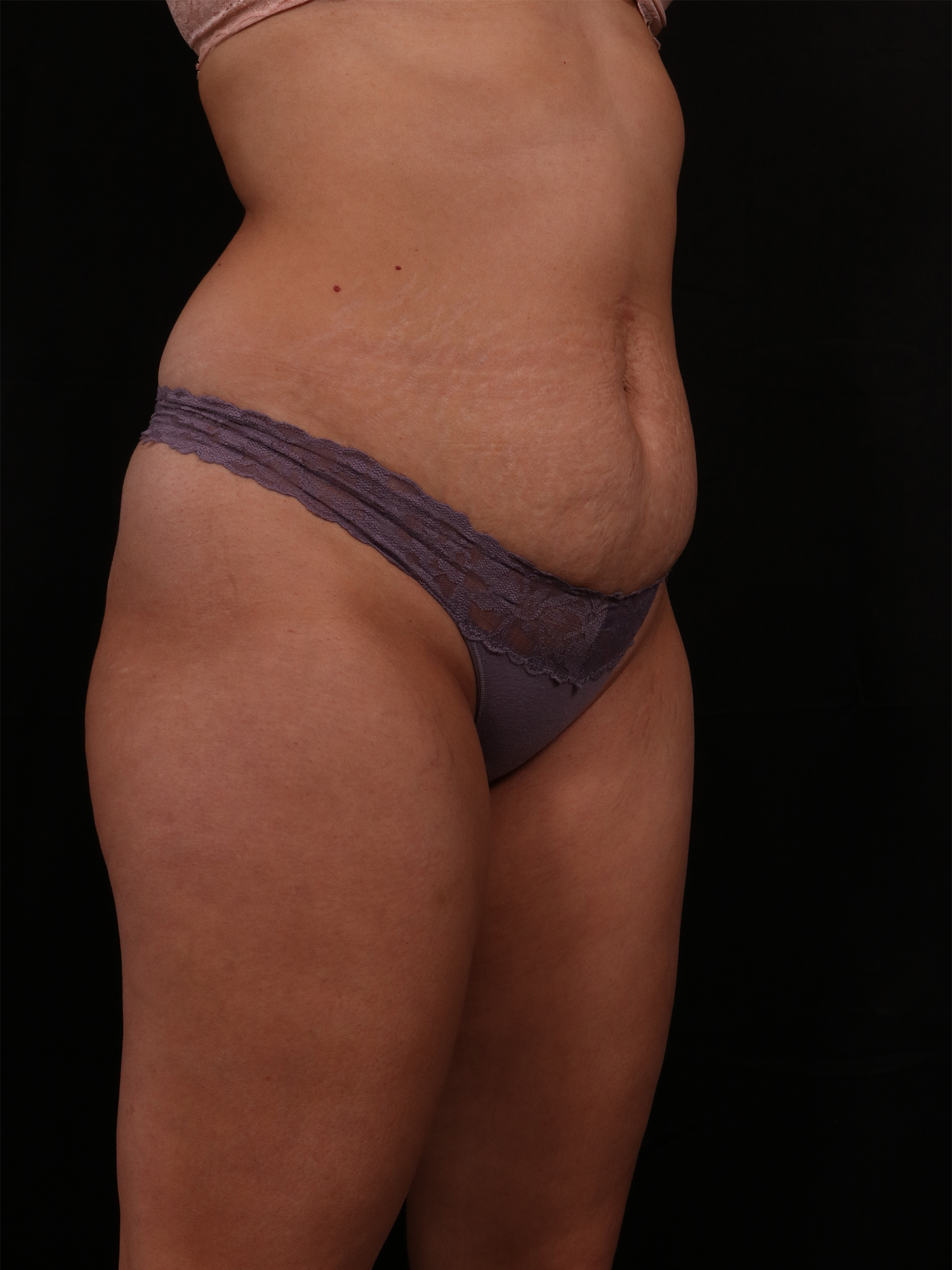 Before Image: Tummy Tuck - right-front-oblique