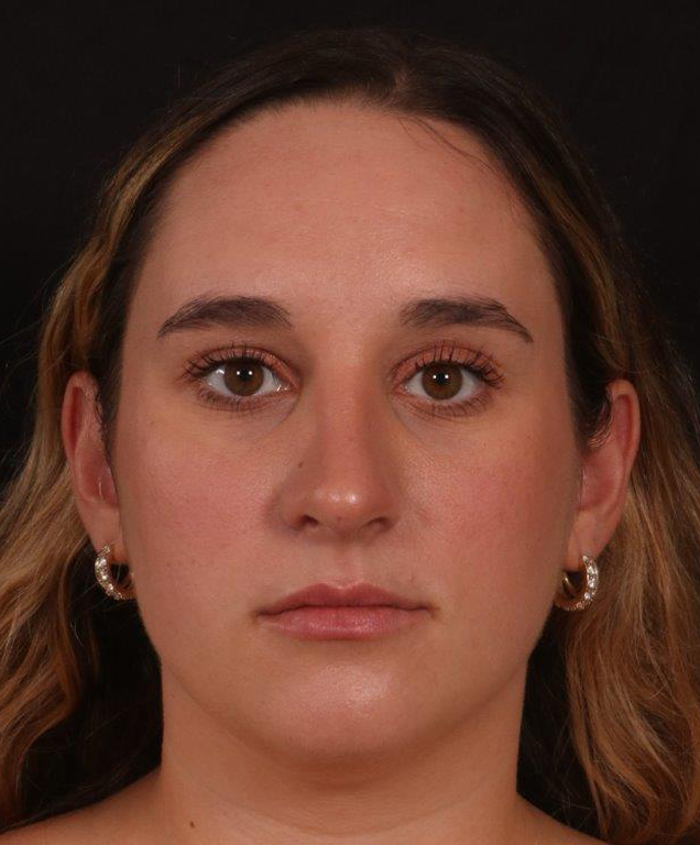 After Image: Rhinoplasty - front