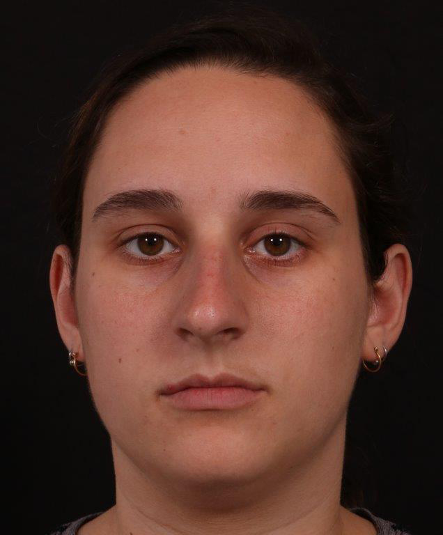 Before Image: Rhinoplasty - front